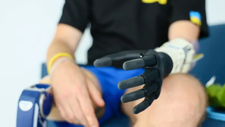 Біонічний протез є функціональним і повторює анатомію справжньої руки | © https://telegraf.com.ua/